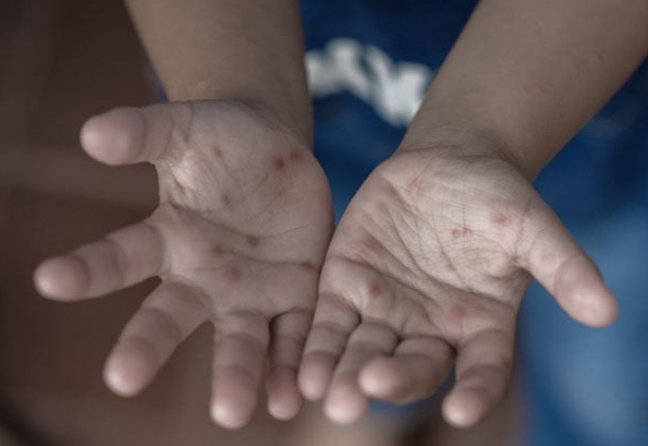 Imigrante registra aumento de casos de mão-pé-boca e reforça orientações a famílias e escolas